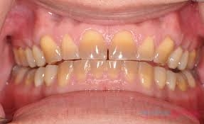 Nhiễm màu răng - Nguyên nhân và cách điều trị