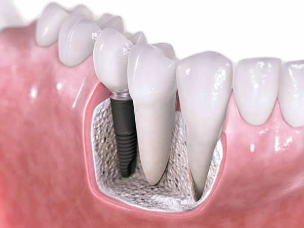 Chăm sóc sau cấy ghép implant