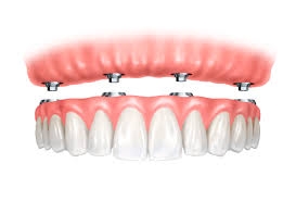 Khớp cắn cho implant