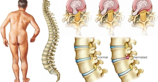 Bệnh thoát vị đĩa đệm: Triệu chứng, nguyên nhân và cách điều trị