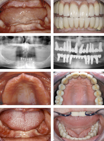 Cấy Implant cho trường hợp mất hết răng