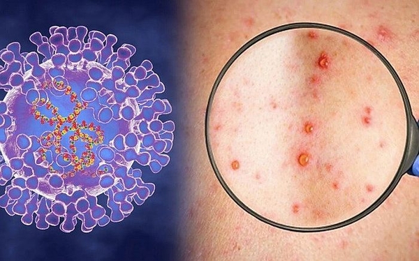 Bệnh đậu mùa khỉ nguy hiểm đến mức nào?