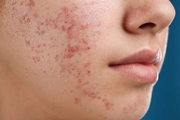 Miếng dán vi kim kết hợp với sóng siêu âm để tiêu diệt vi khuẩn gây mụn