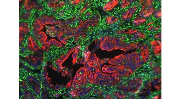 Nghiên cứu mới xác định protein liên quan đến di căn trong ung thư tuyến tụy