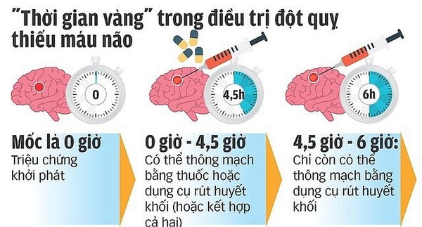 “Giờ vàng” trong cấp cứu, điều trị bệnh nhân đột quỵ não