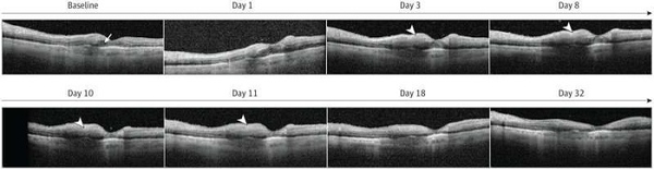 Phát hiện tác dụng phụ sau điều trị các bệnh về mắt bằng faricimab