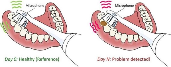 Phát hiện sớm sức khỏe răng miệng bằng bàn chải đánh răng siêu âm cảm biến mới