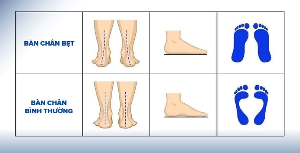 Bàn chân bẹt ở trẻ: Một số điều cha mẹ cần biết