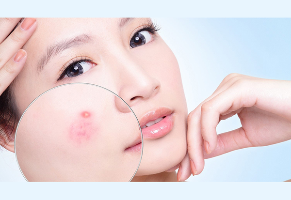 Điều trị dứt điểm mụn
