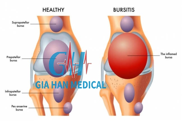 Siêu âm trị liệu trong <br>điều trị viêm bao hoạt dịch khớp