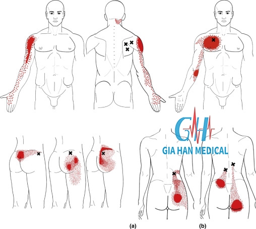 Siêu âm trị liệu trong điều trị <br>hội chứng đau cân cơ