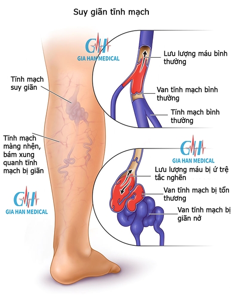 Suy giãn tĩnh mạch là gì ?