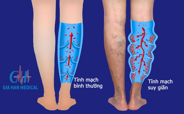 Nguyên nhân gây ra bệnh suy giãn tĩnh mạch?