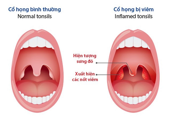 benh-viem-hong-man-tinh-va-giai-phap-huu-hieu