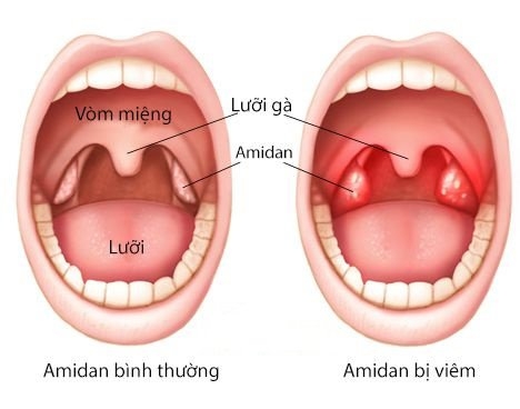 rau-trai-vi-thuoc-ho-tro-dieu-tri-viem-hong-hieu-qua