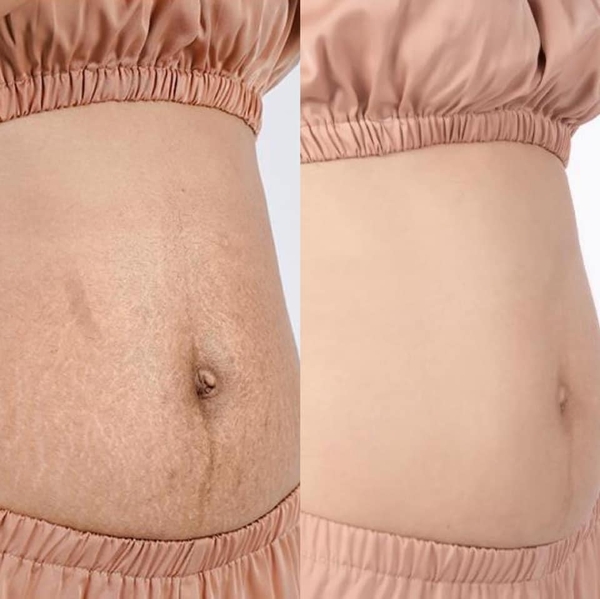 Kem trị rạn da và chống sẹo Stretcheal Anti Stretch Marks & Scars Cream