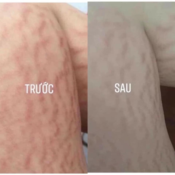 Kem trị rạn da và chống sẹo Stretcheal Anti Stretch Marks & Scars Cream