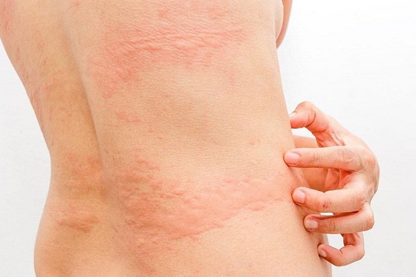 Các bệnh da liễu thường gặp khi thời tiết thay đổi