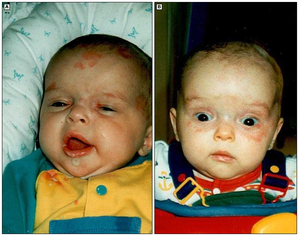 LUPUS SƠ SINH | PGS. TS. BS. Hoàng Thị Lâm