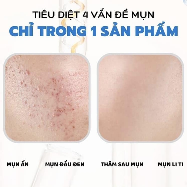 Gel trị mụn giảm thâm Ezanic 20%