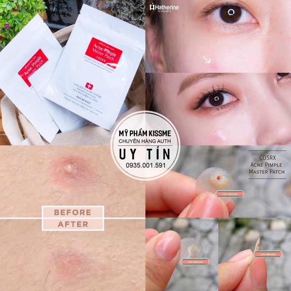 Miếng Dán Mụn Cosrx Acne Pimple Master Patch