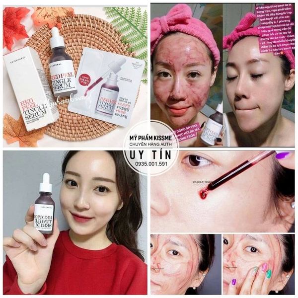 Tinh Chất Tẩy Da Chết Hóa Học So' Natural Red Peel Tingle Serum