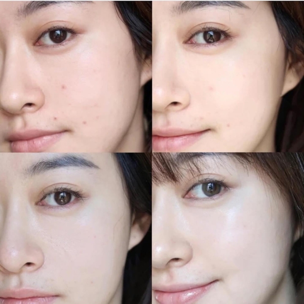 Serum ngừa mụn mờ thâm Balance Niacinamide Blemish Recovery Serum 30ml