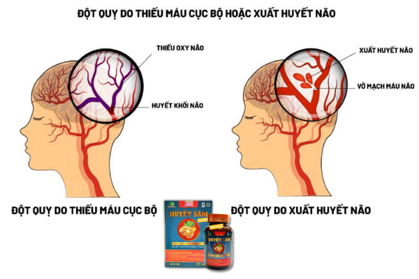 Tai biến mạch máu não là gì? Nguyên nhân và triệu chứng gây tai biến mạch máu não?