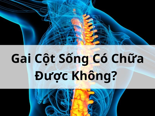 Gai Cột Sống Có Chữa Được Không? Tìm Hiểu Chi Tiết