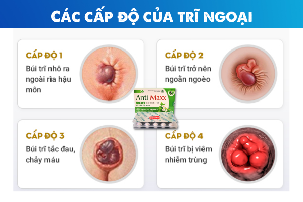 Trĩ độ 1 là gì? Có cần phải phẫu thuật không?