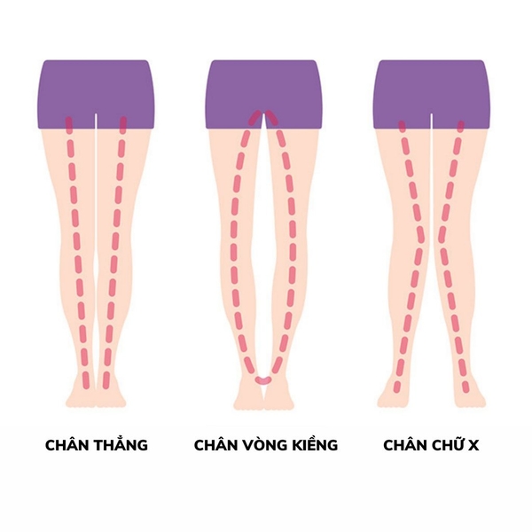 Trẻ bị chân vòng kiềng liệu có mắc bệnh xương khớp không?