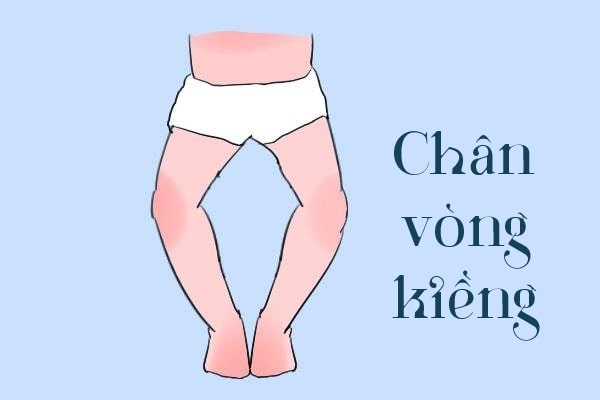Nguyên nhân trẻ bị chân vòng kiềng