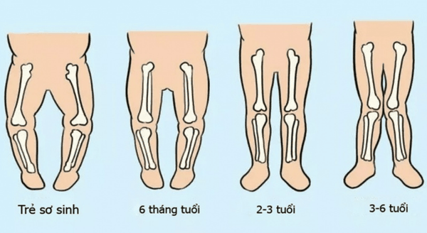 Chân vòng kiềng là gì?