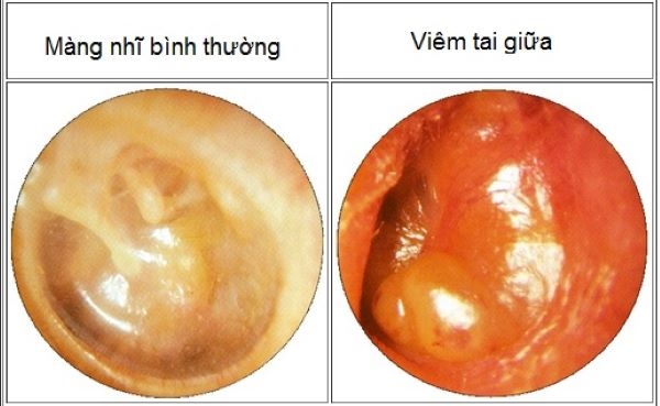 Dấu hiệu viêm V.A