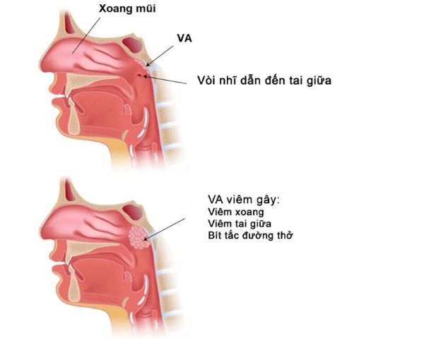 Dấu hiệu viêm V.A