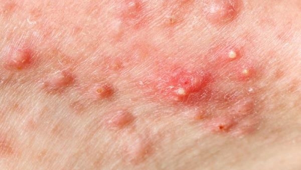 Tự ý nặn mụn trứng cá