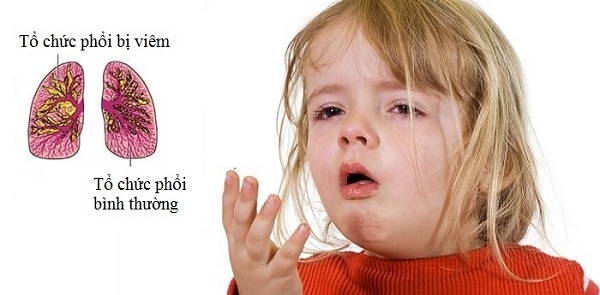 Viêm phổi là gì?