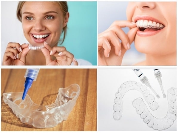 Nên tẩy trắng răng tại nhà hay tới nha khoa?
