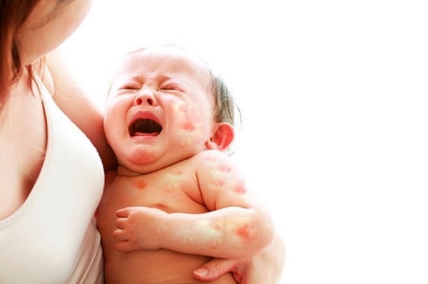 Nguyên nhân bé bị dị ứng sữa