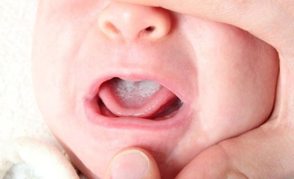 triệu chứng viêm họng ở trẻ sơ sinh
