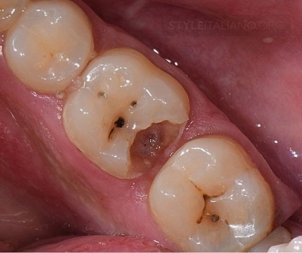 Vệ sinh răng miệng sạch sẽ nhưng vẫn bị hôi miệng?