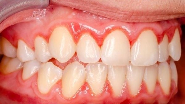 Viêm răng lợi do vệ sinh răng miệng không đúng cách
