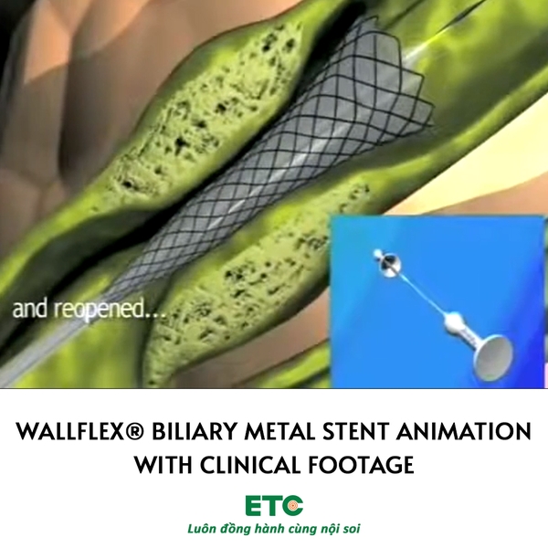 WallFlex® Biliary Metal Stent animation with clinical footage