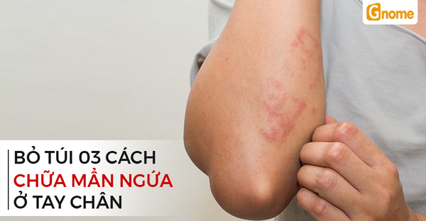 Bỏ túi 3 cách hay nhất để chữa nổi mẫn ngứa ở tay chân