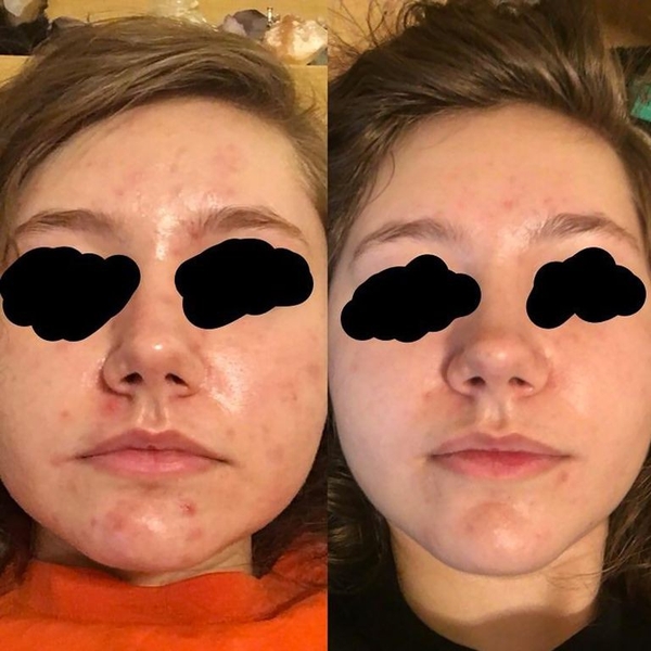 Dưỡng chất Dầu Tầm Xuân The Ordinary 100% Organic Cold-Pressed Rose Hip Seed Oil