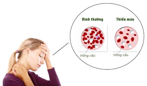 RỤNG TÓC DO THIẾU MÁU, THIẾU SẮT
