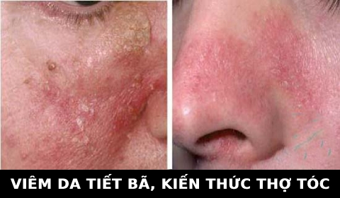 VIÊM DA TIẾT BÃ. KIẾN THỨC THỢ TÓC CẦN BIẾT