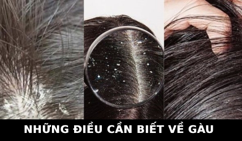 BỆNH GÀU LÀ GÌ? KIẾN THỨC THỢ TÓC CẦN BIẾT