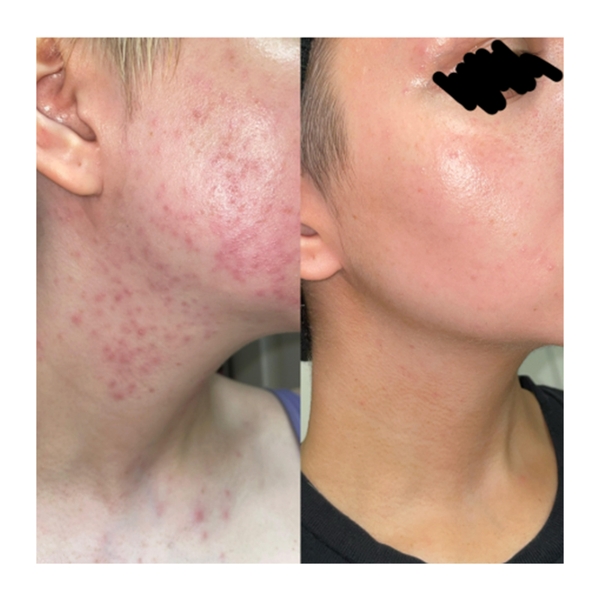 Differin Adapalene Gel 0.1%: Giải Pháp Trị Mụn Retinoid Chuẩn Y Khoa Cho Làn Da Sạch Mụn