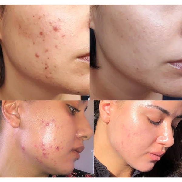 Bailleu Tretin Cream 0.05%: "Tiêu Chuẩn Vàng" Trong Điều Trị Mụn, Trẻ Hóa Da & Hiệu Chỉnh Sắc Tố